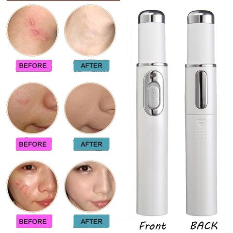 Acne Laser Pen Soft Scar Wrinkle Removal Treatment Device